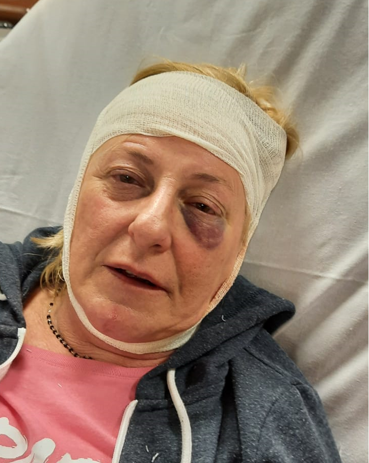 La denuncia di una alessandrina, aggredita da un vicino di casa: “Mi ha spinta giù dalle scale e mi ha tirato un pugno”