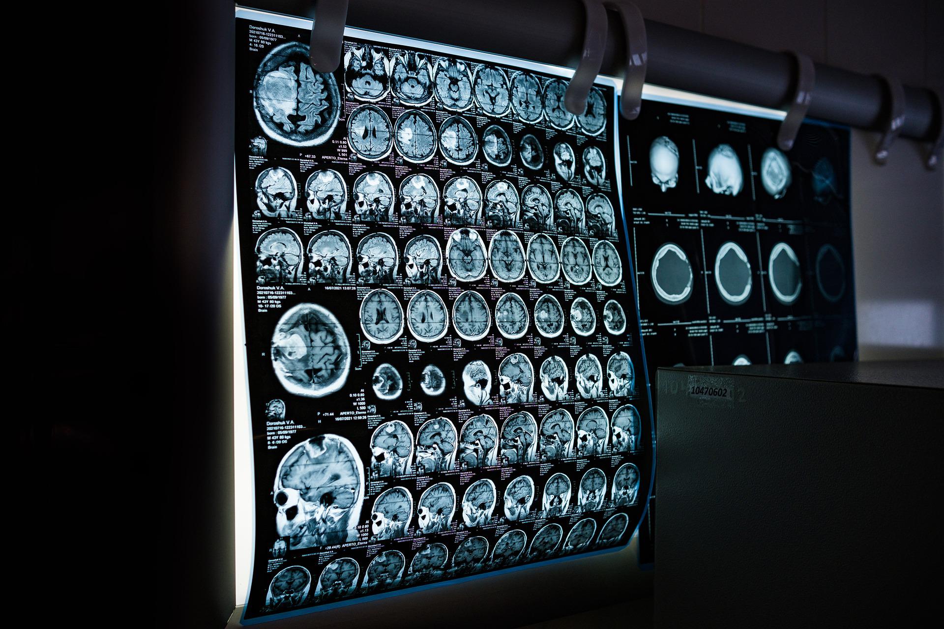 Due premi internazionali per i reparti di Neurologia degli ospedali di Novi e Casale Monferrato