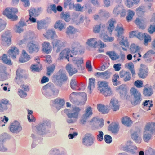 Nuove speranze contro la leucemia mieloide acuta: cellule “killer” sviluppate a Monza