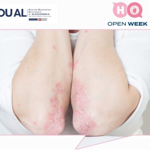 Psoriasi, all’Ospedale di Alessandria visite dermatologiche gratuite l’11 marzo