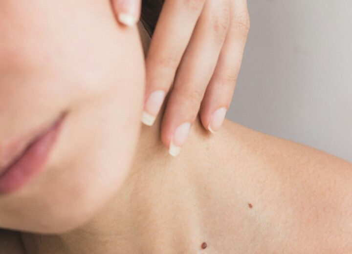 24 maggio, Giornata Europea del Melanoma: cresce l’attenzione sulla prevenzione dei tumori della pelle
